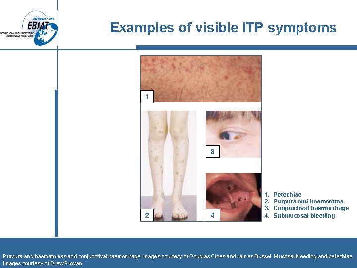Examples of visible ITP symptoms 1 3 2 4 1. 2. 3. 4. Petechiae