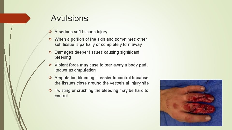 Avulsions A serious soft tissues injury When a portion of the skin and sometimes