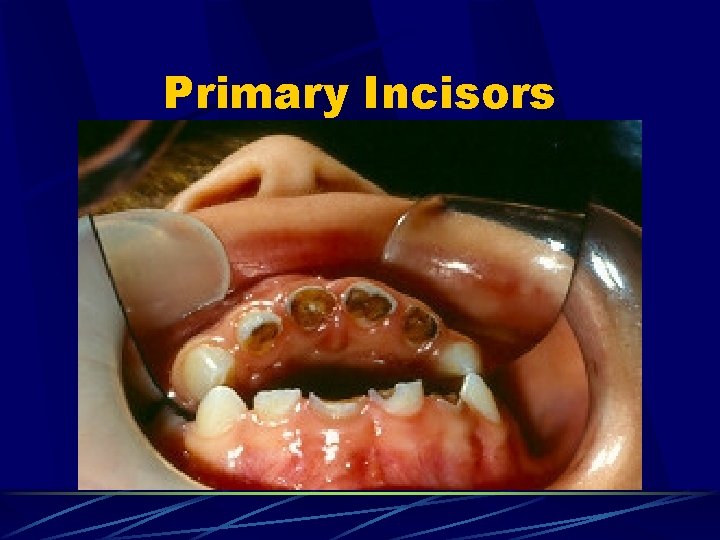 Primary Incisors 