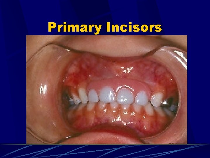 Primary Incisors 