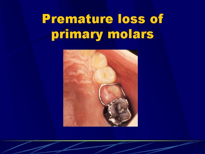 Premature loss of primary molars 