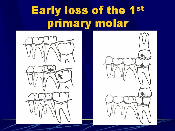 Early loss of the primary molar st 1 