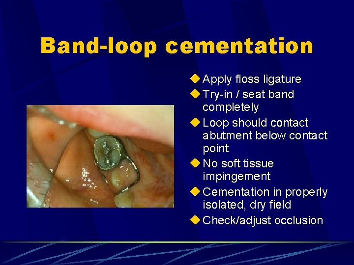Band-loop cementation u Apply floss ligature u Try-in / seat band completely u Loop
