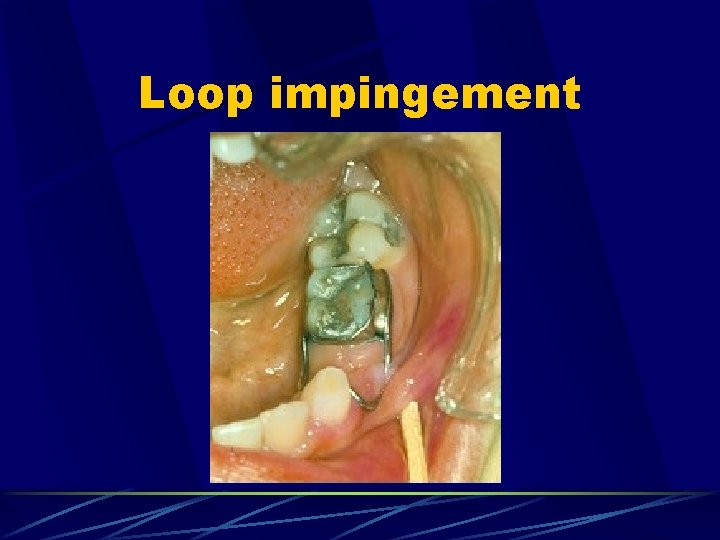 Loop impingement 