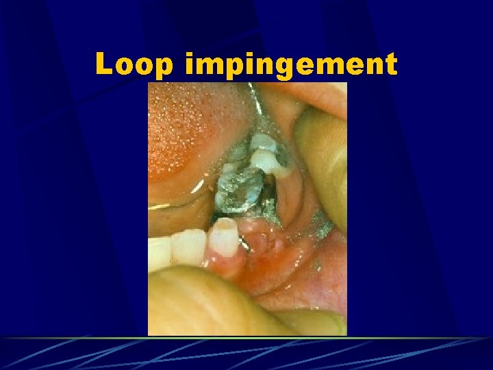 Loop impingement 