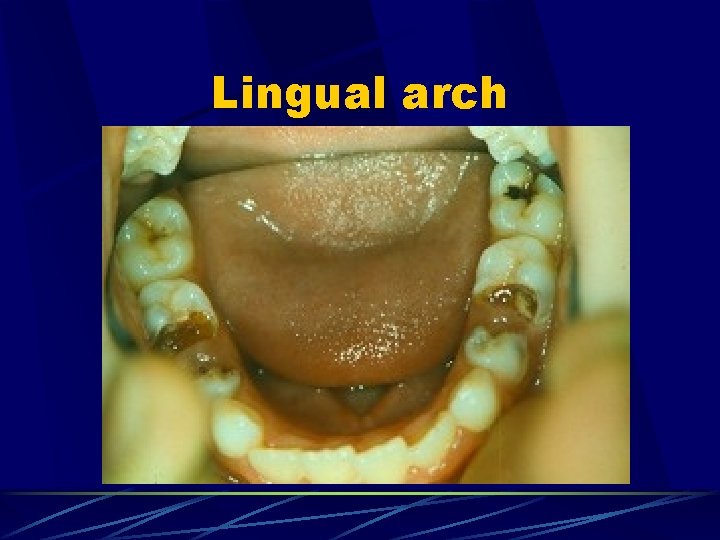 Lingual arch 