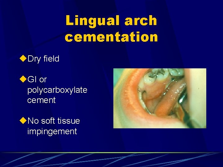 Lingual arch cementation u. Dry field u. GI or polycarboxylate cement u. No soft