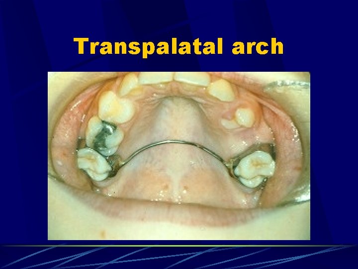 Transpalatal arch 