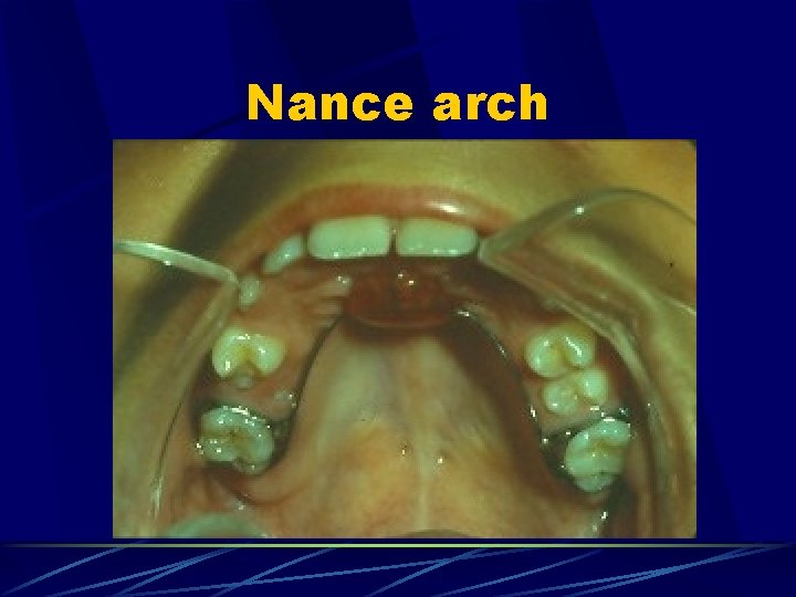 Nance arch 