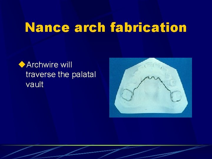 Nance arch fabrication u. Archwire will traverse the palatal vault 