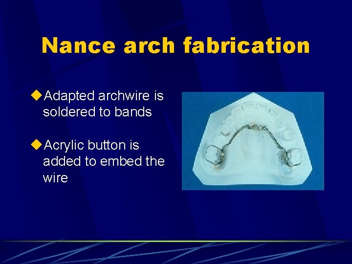 Nance arch fabrication u. Adapted archwire is soldered to bands u. Acrylic button is