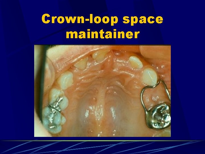 Crown-loop space maintainer 