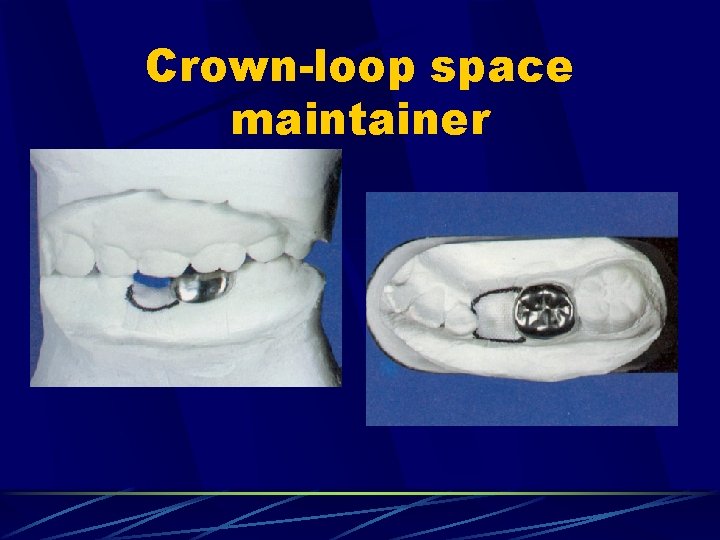 Crown-loop space maintainer 