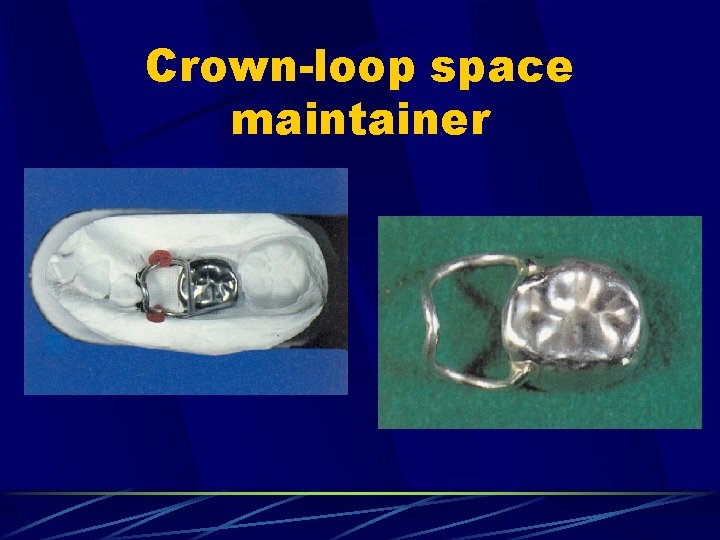 Crown-loop space maintainer 