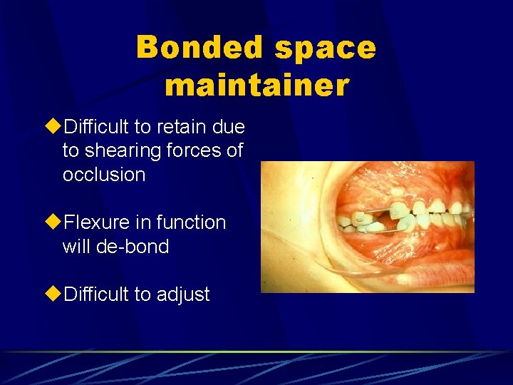 Bonded space maintainer u. Difficult to retain due to shearing forces of occlusion u.