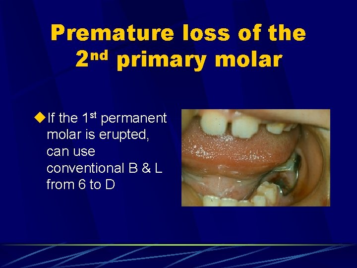 Premature loss of the 2 nd primary molar u. If the 1 st permanent