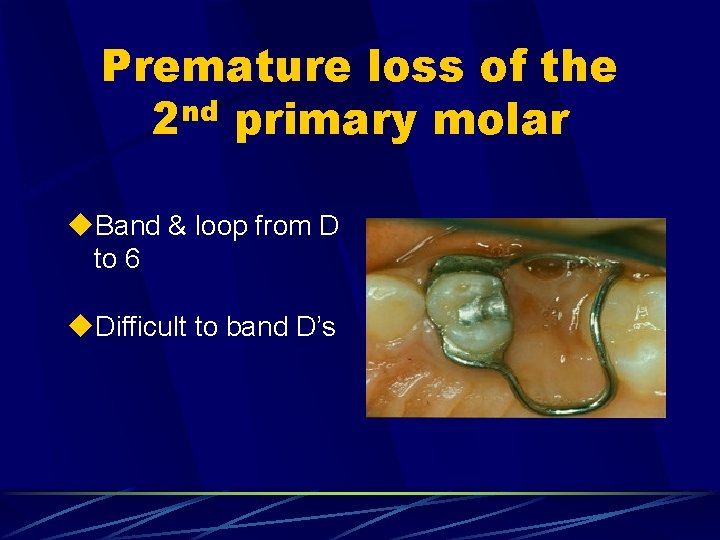 Premature loss of the 2 nd primary molar u. Band & loop from D