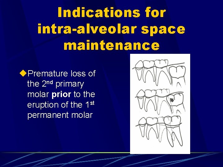Indications for intra-alveolar space maintenance u. Premature loss of the 2 nd primary molar
