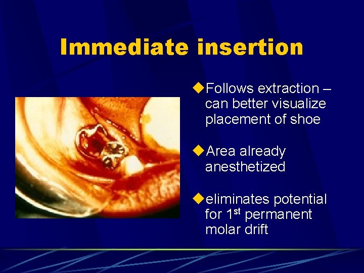 Immediate insertion u. Follows extraction – can better visualize placement of shoe u. Area