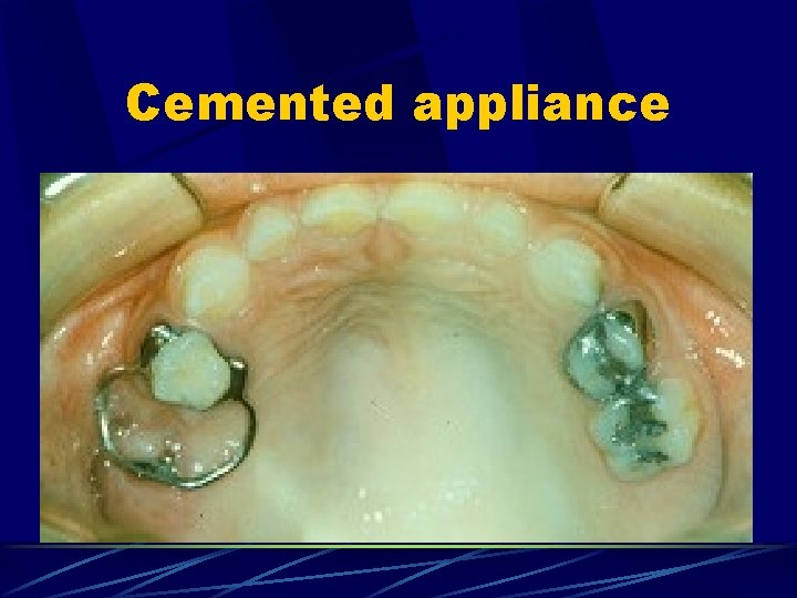 Cemented appliance 