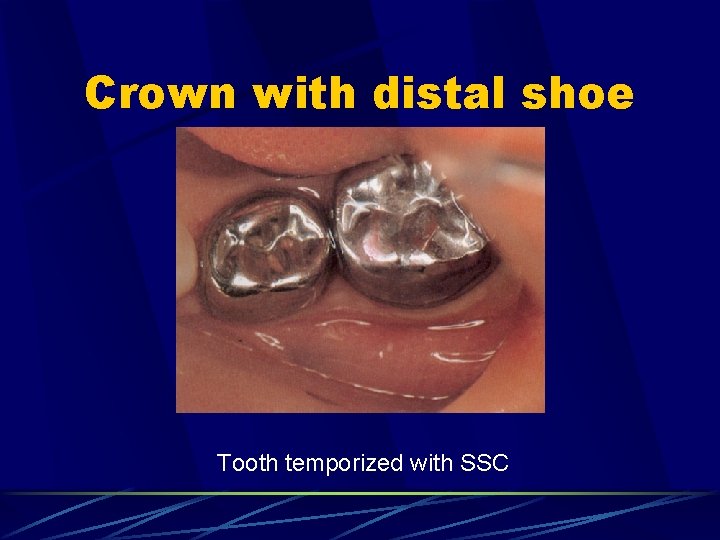 Crown with distal shoe Tooth temporized with SSC 