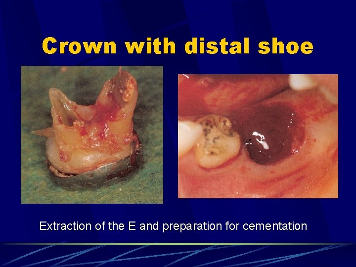 Crown with distal shoe Extraction of the E and preparation for cementation 