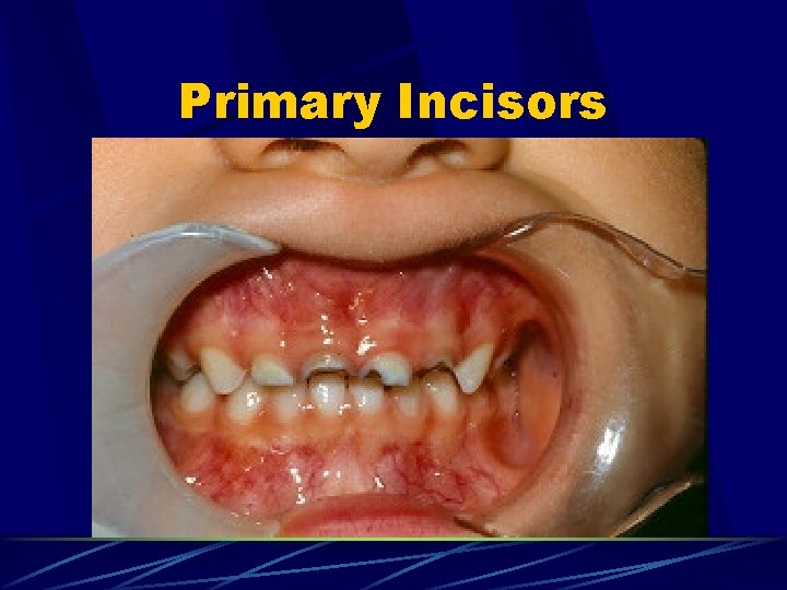 Primary Incisors 