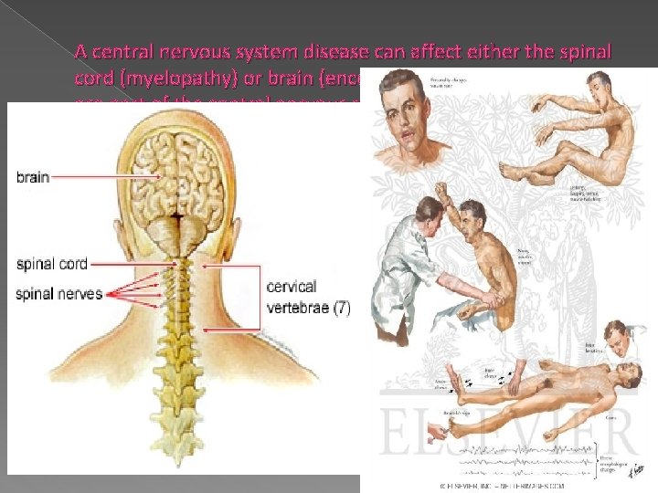 A central nervous system disease can affect either the spinal cord (myelopathy) or brain