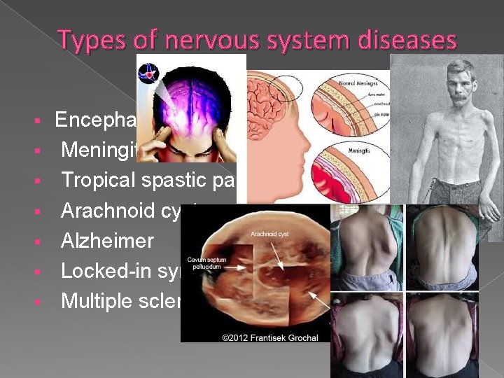 Types of nervous system diseases § § § § Encephalitis Meningitis Tropical spastic paraparesis