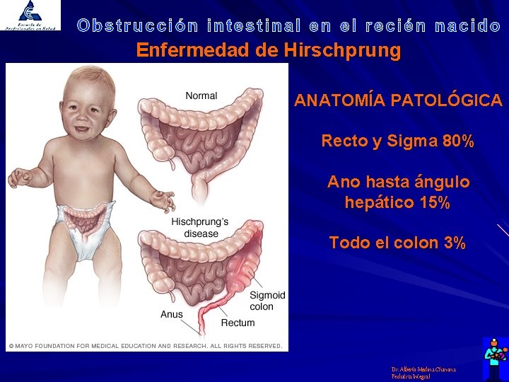 Enfermedad de Hirschprung ANATOMÍA PATOLÓGICA Recto y Sigma 80% Ano hasta ángulo hepático 15%