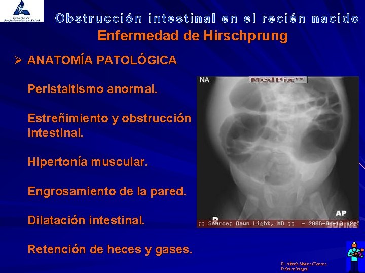 Enfermedad de Hirschprung Ø ANATOMÍA PATOLÓGICA Peristaltismo anormal. Estreñimiento y obstrucción intestinal. Hipertonía muscular.