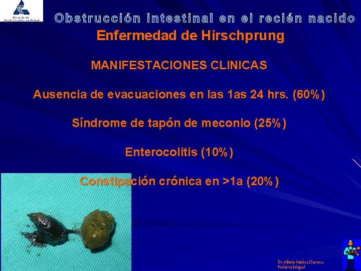 Enfermedad de Hirschprung MANIFESTACIONES CLINICAS Ausencia de evacuaciones en las 1 as 24 hrs.