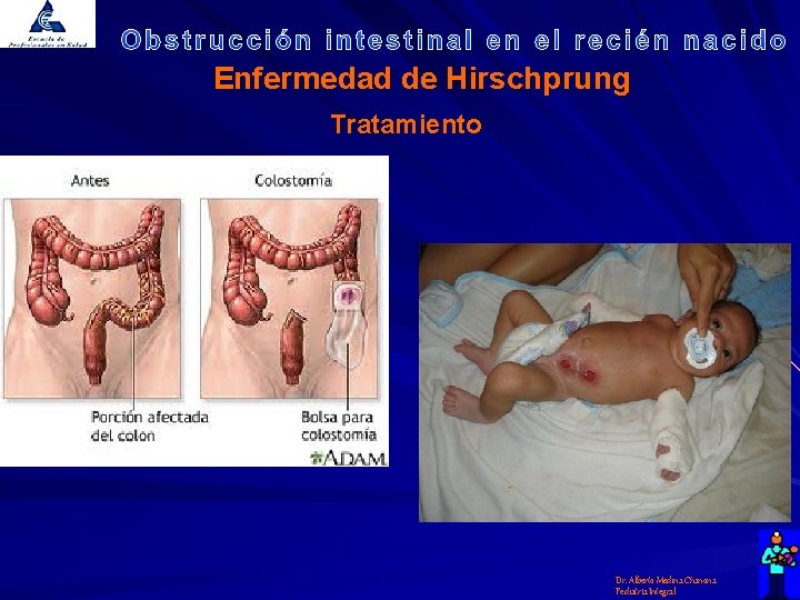 Enfermedad de Hirschprung Tratamiento Dr. Alberto Medina Chanona Pediatría Integral 