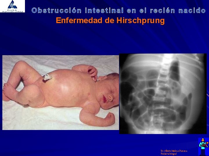 Enfermedad de Hirschprung Dr. Alberto Medina Chanona Pediatría Integral 