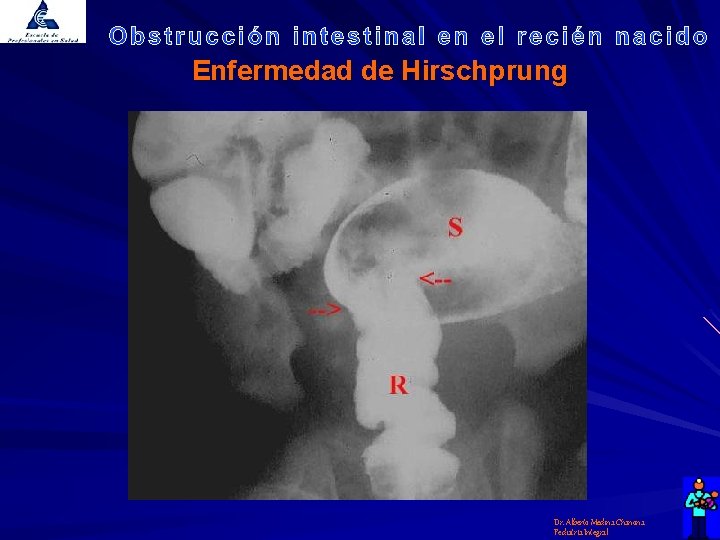 Enfermedad de Hirschprung Dr. Alberto Medina Chanona Pediatría Integral 