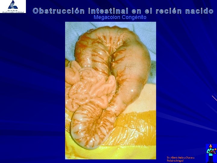 Megacolon Congénito Dr. Alberto Medina Chanona Pediatría Integral 