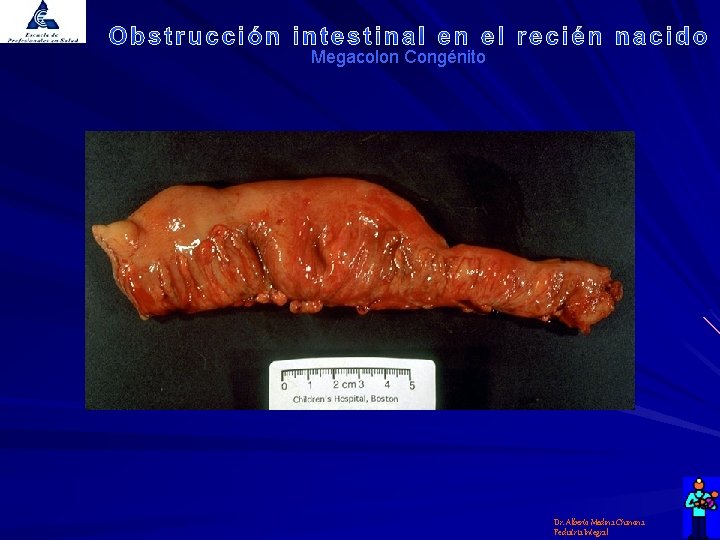 Megacolon Congénito Dr. Alberto Medina Chanona Pediatría Integral 