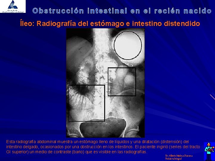 Íleo: Radiografía del estómago e intestino distendido Esta radiografía abdominal muestra un estómago lleno