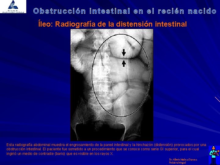 Íleo: Radiografía de la distensión intestinal Esta radiografía abdominal muestra el engrosamiento de la