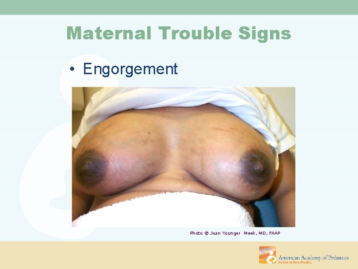 Maternal Trouble Signs • Engorgement Photo © Joan Younger Meek, MD, FAAP 