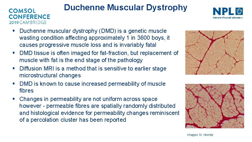 Duchenne Muscular Dystrophy § Duchenne muscular dystrophy (DMD) is a genetic muscle wasting condition