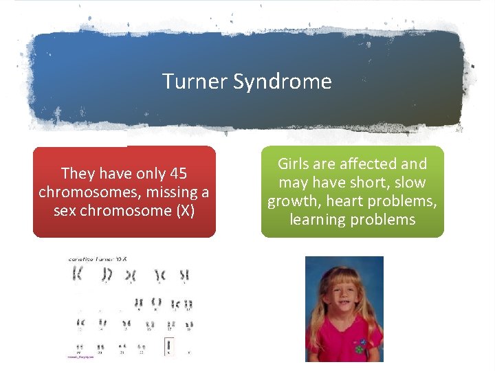 Turner Syndrome They have only 45 chromosomes, missing a sex chromosome (X) Girls are