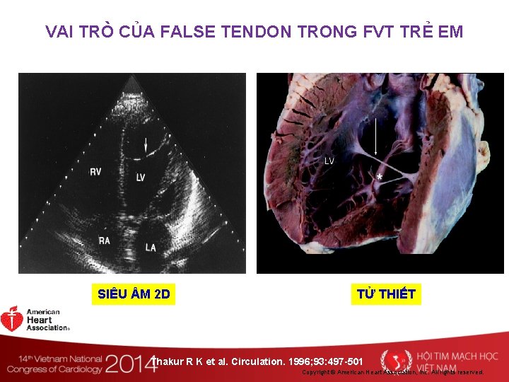 VAI TRÒ CỦA FALSE TENDON TRONG FVT TRẺ EM SIÊU M 2 D TỬ