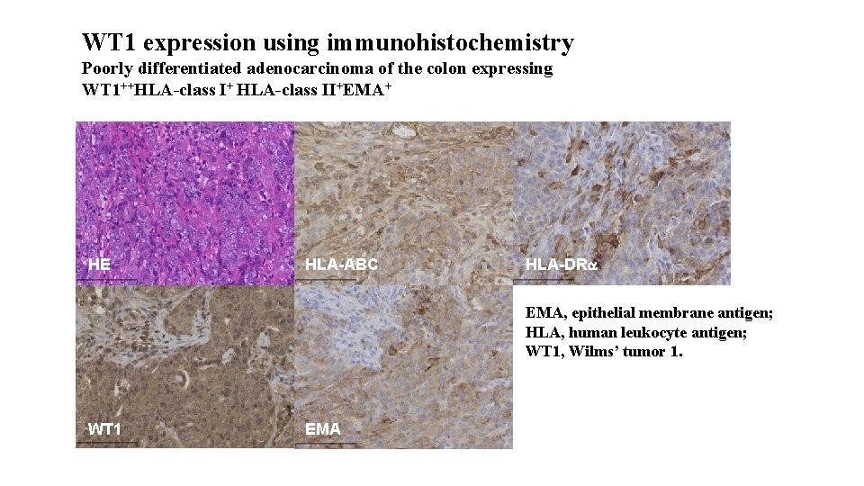 WT 1 expression using immunohistochemistry Poorly differentiated adenocarcinoma of the colon expressing WT 1++HLA-class