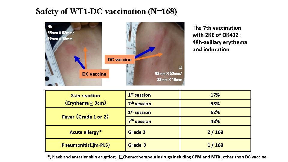 Safety of WT 1 -DC vaccination (N=168) The 7 th vaccination with 2 KE