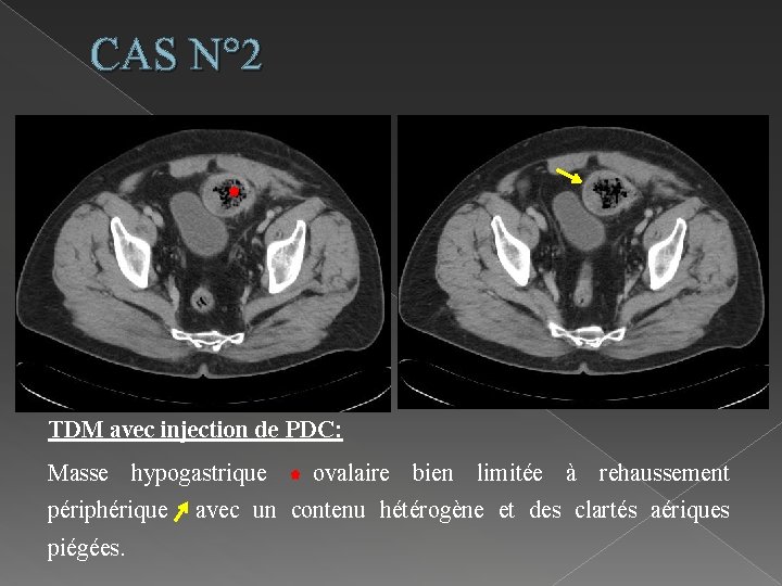 CAS N° 2 TDM avec injection de PDC: Masse hypogastrique périphérique piégées. ovalaire bien