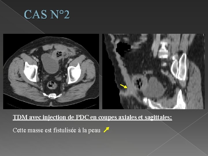 CAS N° 2 TDM avec injection de PDC en coupes axiales et sagittales: Cette