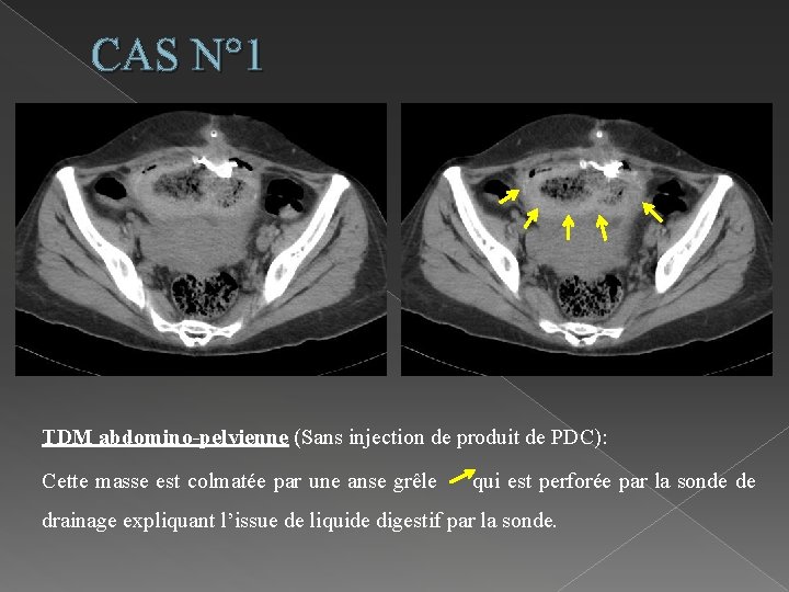 CAS N° 1 TDM abdomino-pelvienne (Sans injection de produit de PDC): Cette masse est