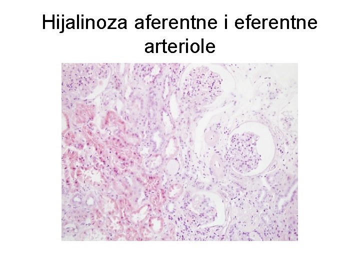 Hijalinoza aferentne i eferentne arteriole 