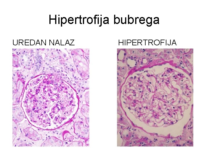 Hipertrofija bubrega UREDAN NALAZ HIPERTROFIJA 